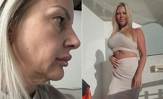Žena zhubla a měla krk jako krocan. K dokonalému vzhledu jí pomohla plastika